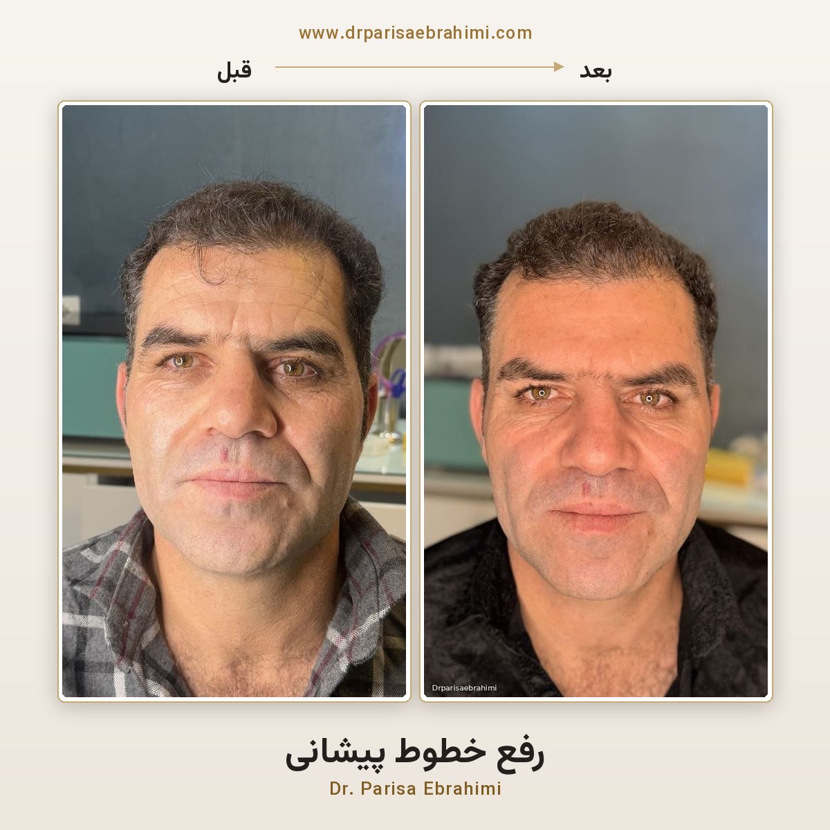 رفع خطوط پیشانی در تهران — ارزیابی خطوط پویا و ثابت پیشانی، کلینیک دکتر پریسا ابراهیمی میرداماد