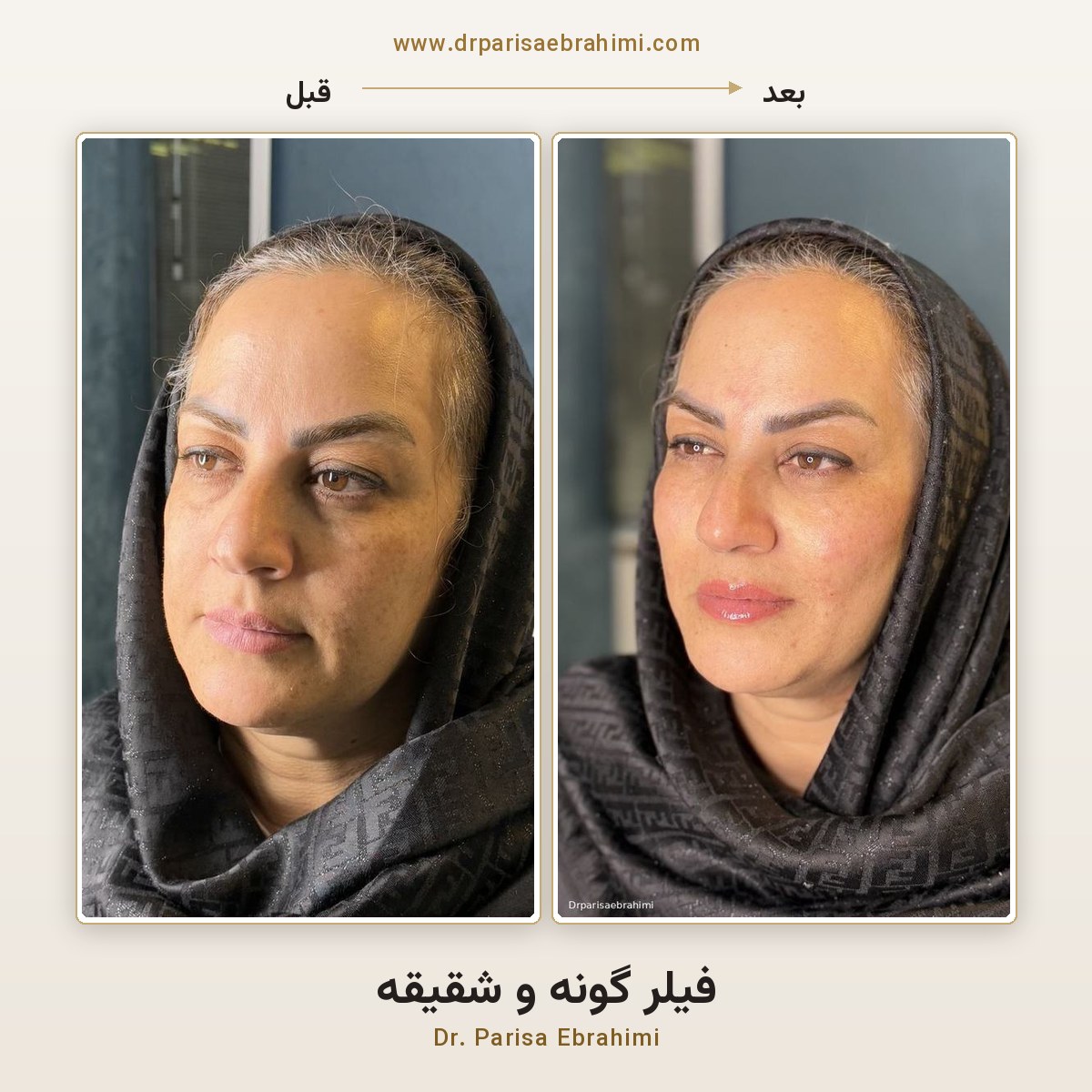 قبل و بعد تزریق فیلر صورت و گونه در تهران — دکتر پریسا ابراهیمی، کلینیک میرداماد