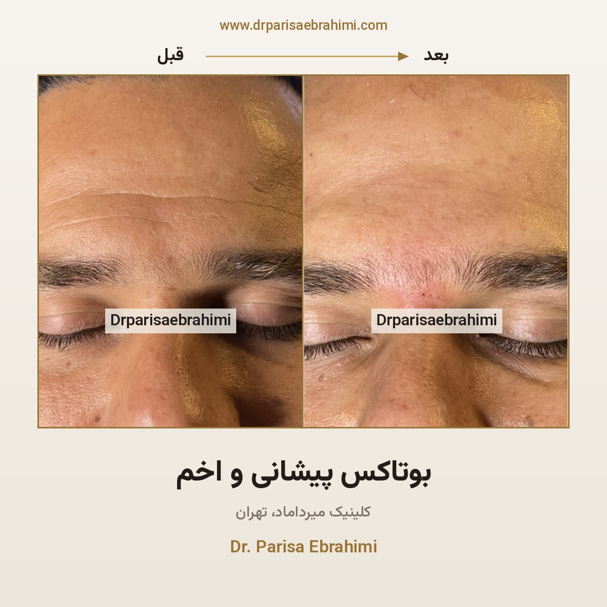قبل و بعد بوتاکس پیشانی و خطوط اخم در تهران — کاهش خط افقی پیشانی در آقایان، دکتر پریسا ابراهیمی، کلینیک میرداماد