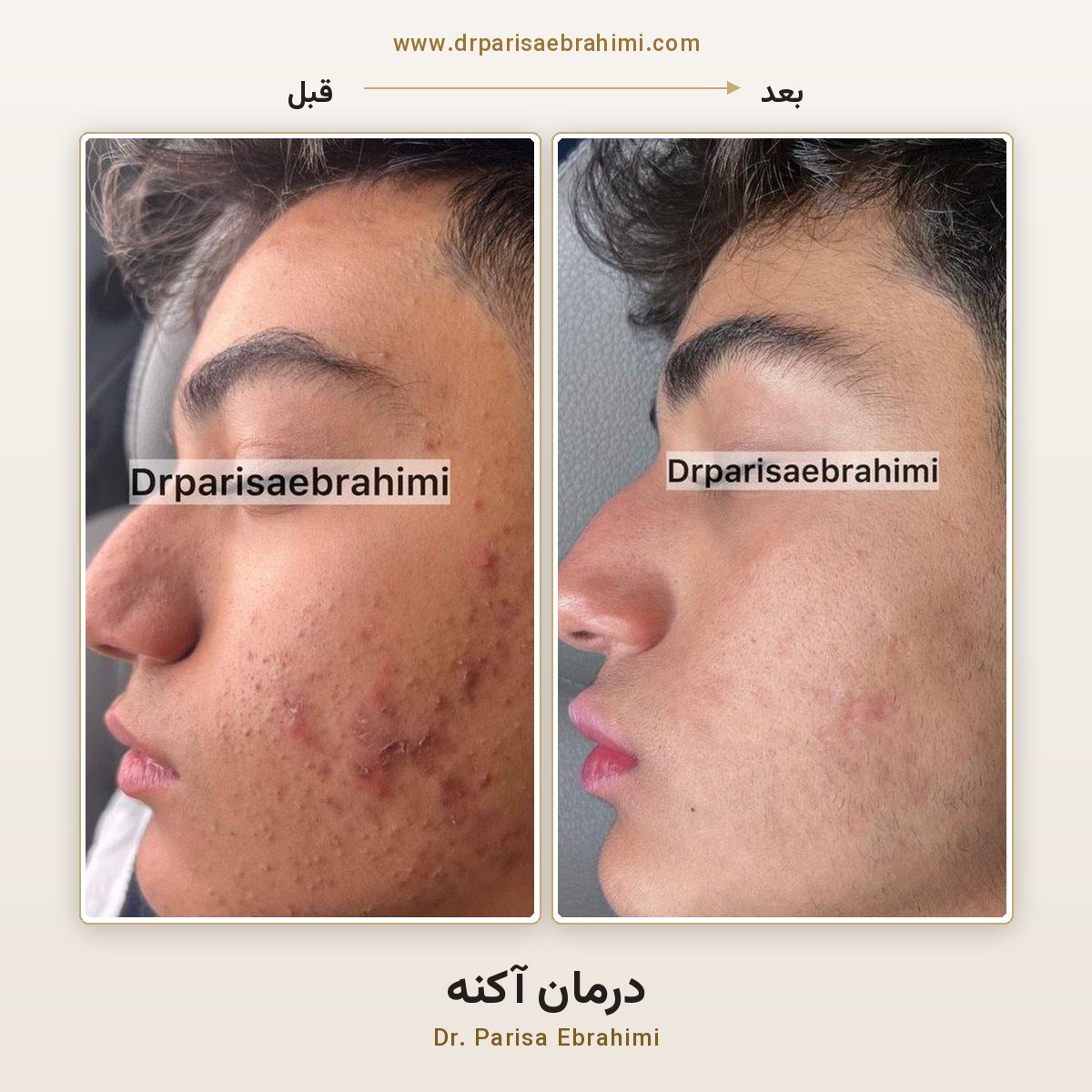 قبل و بعد درمان جوش و آکنه صورت در تهران — پروتکل ترکیبی دکتر پریسا ابراهیمی، میرداماد