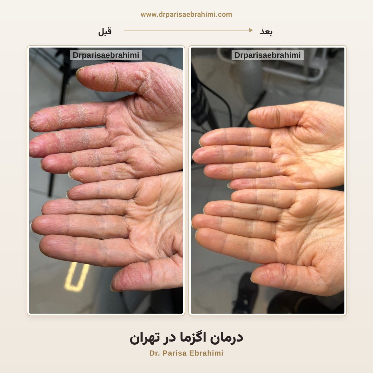 قبل و بعد درمان اگزما در تهران — کاهش قرمزی، پوسته‌ریزی و ترک‌های پوست دست، دکتر پریسا ابراهیمی، کلینیک میرداماد