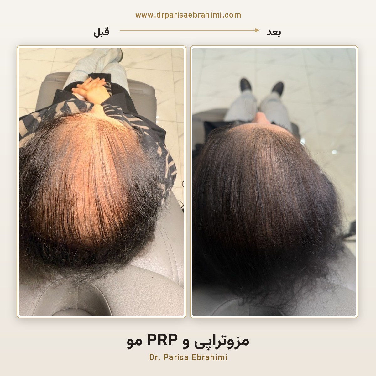قبل و بعد درمان ریزش موی خانمها با مزوتراپی و PRP در تهران — افزایش تراکم موی فرق سر، دکتر پریسا ابراهیمی میرداماد