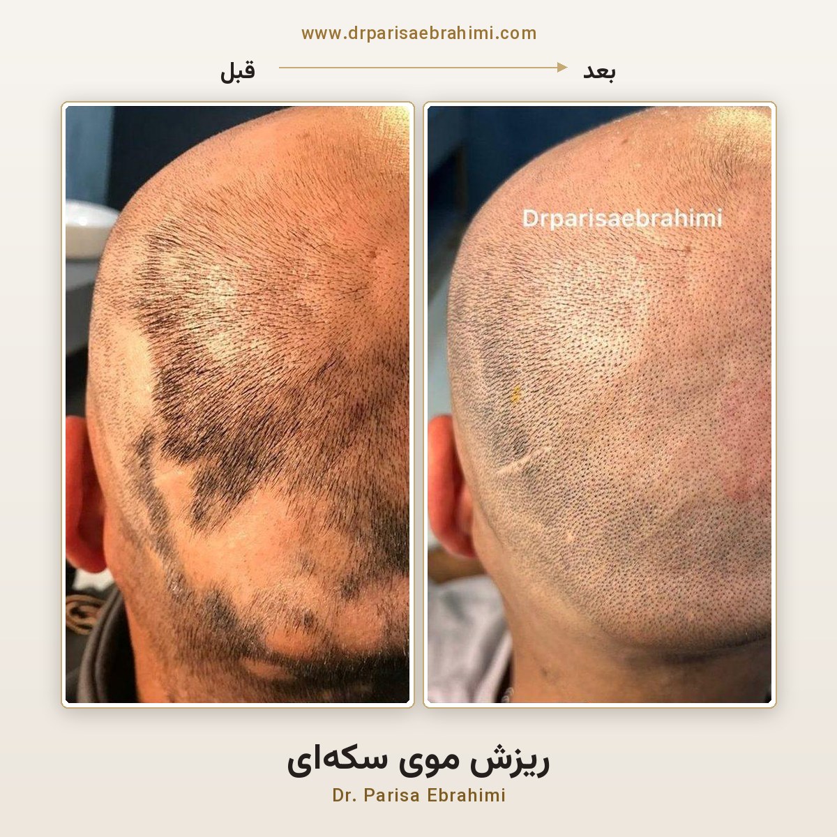 قبل و بعد درمان ریزش موی سکهای (آلوپسی آرهآتا) در تهران — دکتر پریسا ابراهیمی، میرداماد