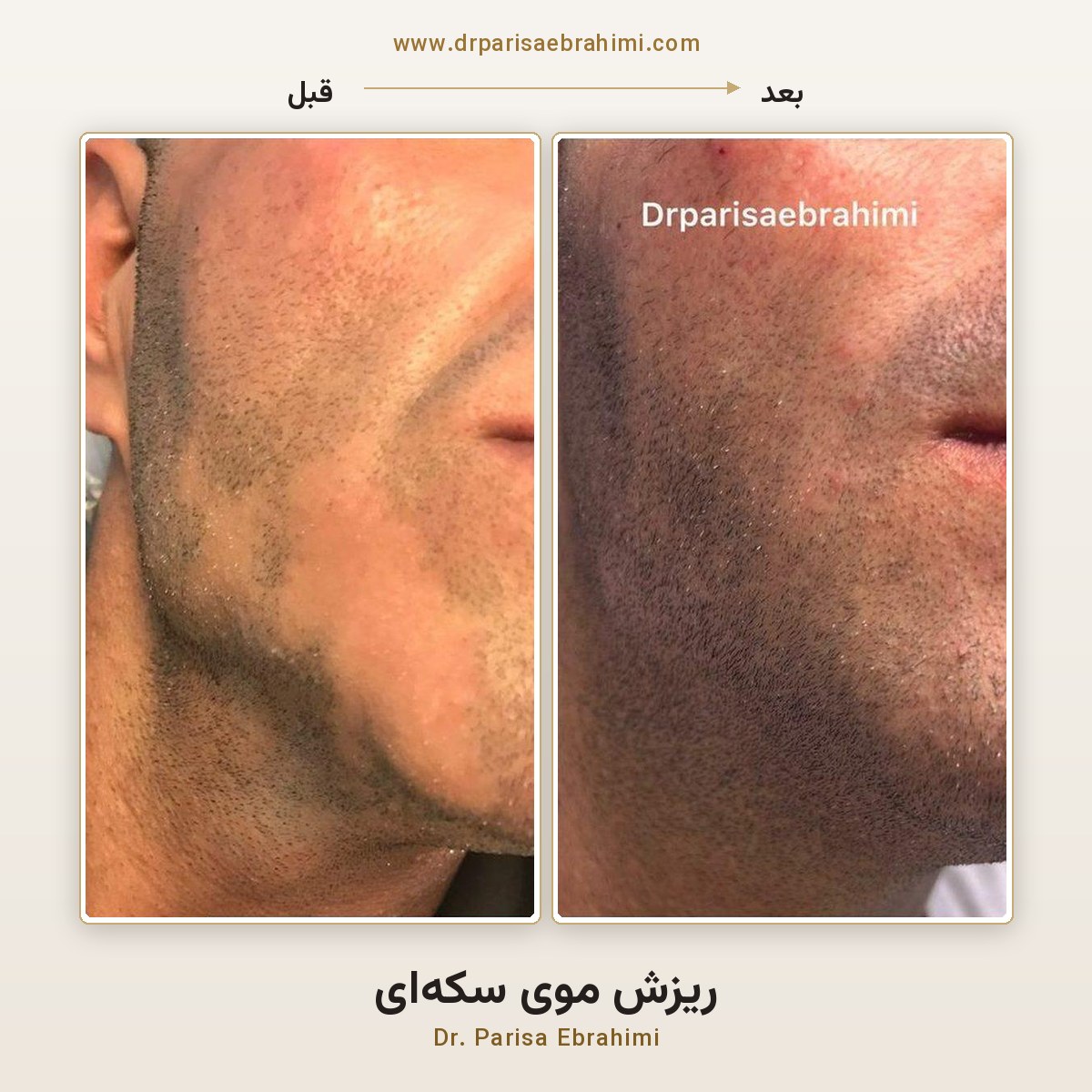 قبل و بعد درمان ریزش سکه‌ای ناحیه ریش در تهران — دکتر پریسا ابراهیمی، کلینیک میرداماد