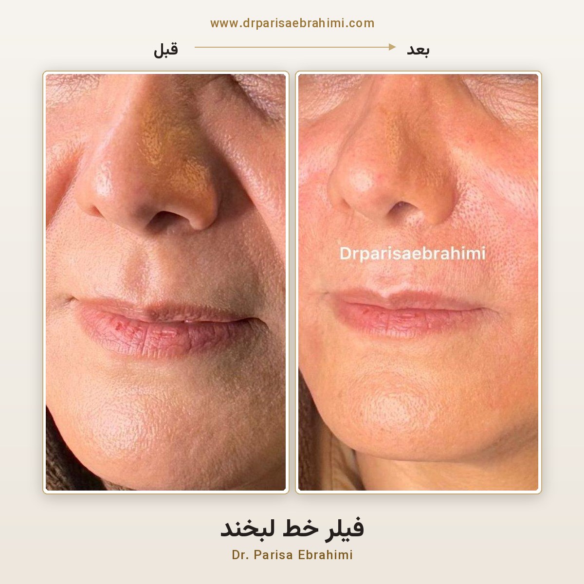 قبل و بعد تزریق فیلر خط لبخند (نازولبیال) در تهران — کلینیک دکتر پریسا ابراهیمی میرداماد