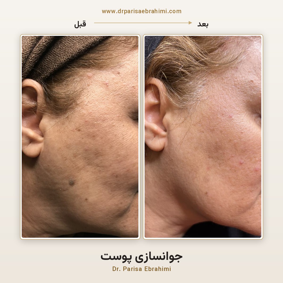قبل و بعد جوانسازی پوست صورت در تهران — دو ماه پس از درمان، دکتر پریسا ابراهیمی میرداماد