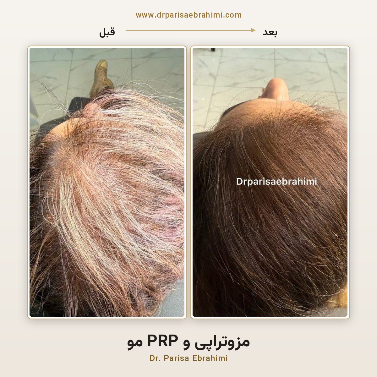 قبل و بعد مزوتراپی مو در تهران — ضخیم‌تر شدن تارهای مو، دکتر پریسا ابراهیمی میرداماد