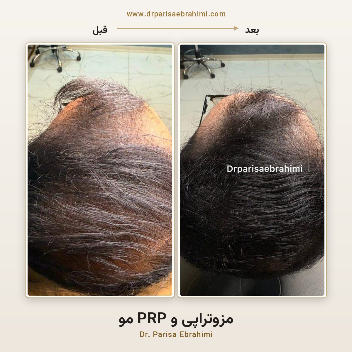 قبل و بعد مزوتراپی و PRP مو در تهران — افزایش تراکم موی فرق سر، دکتر پریسا ابراهیمی میرداماد