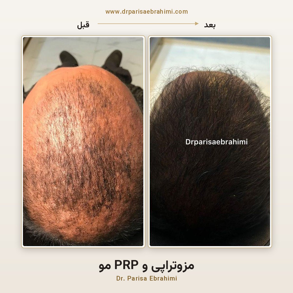قبل و بعد مزوتراپی و PRP موی تاج سر در تهران — دکتر پریسا ابراهیمی، کلینیک میرداماد