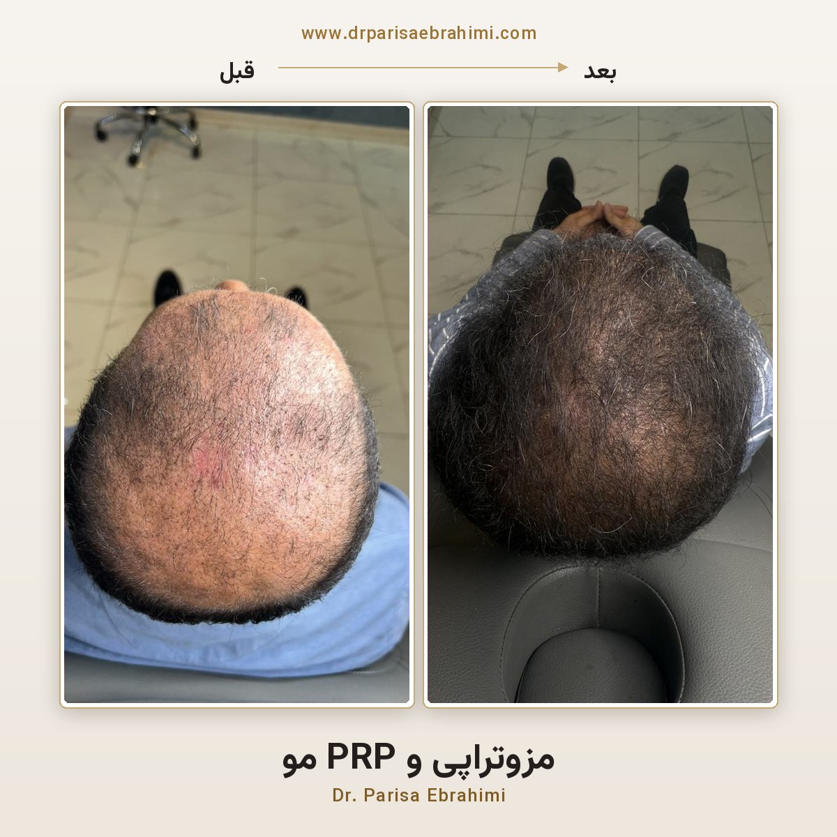 قبل و بعد مزوتراپی و PRP مو در تهران — بازگشت پوشش مو در تاج سر، دکتر پریسا ابراهیمی میرداماد