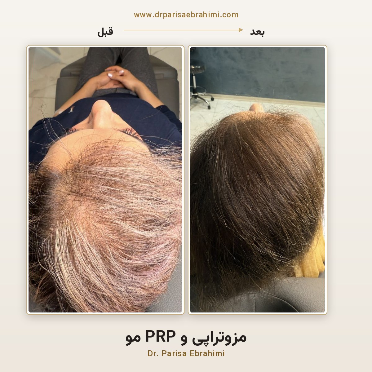 قبل و بعد مزوتراپی و PRP مو در بانوان — افزایش تراکم موی فرق سر، دکتر پریسا ابراهیمی تهران