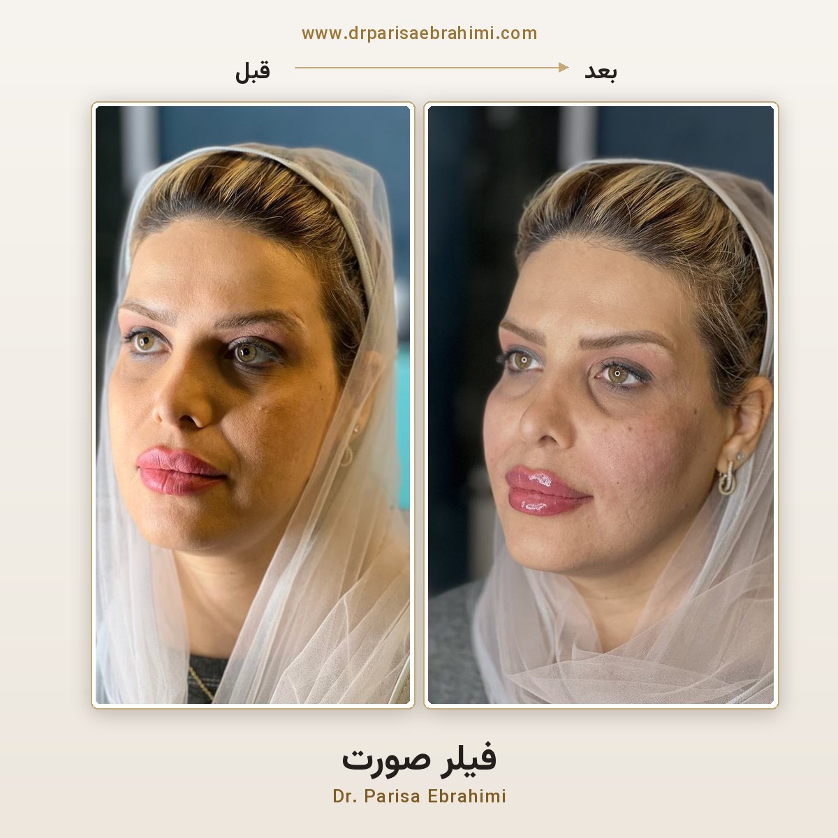 قبل و بعد تزریق فیلر فول فیس در تهران — جوانسازی کامل صورت، دکتر پریسا ابراهیمی میرداماد