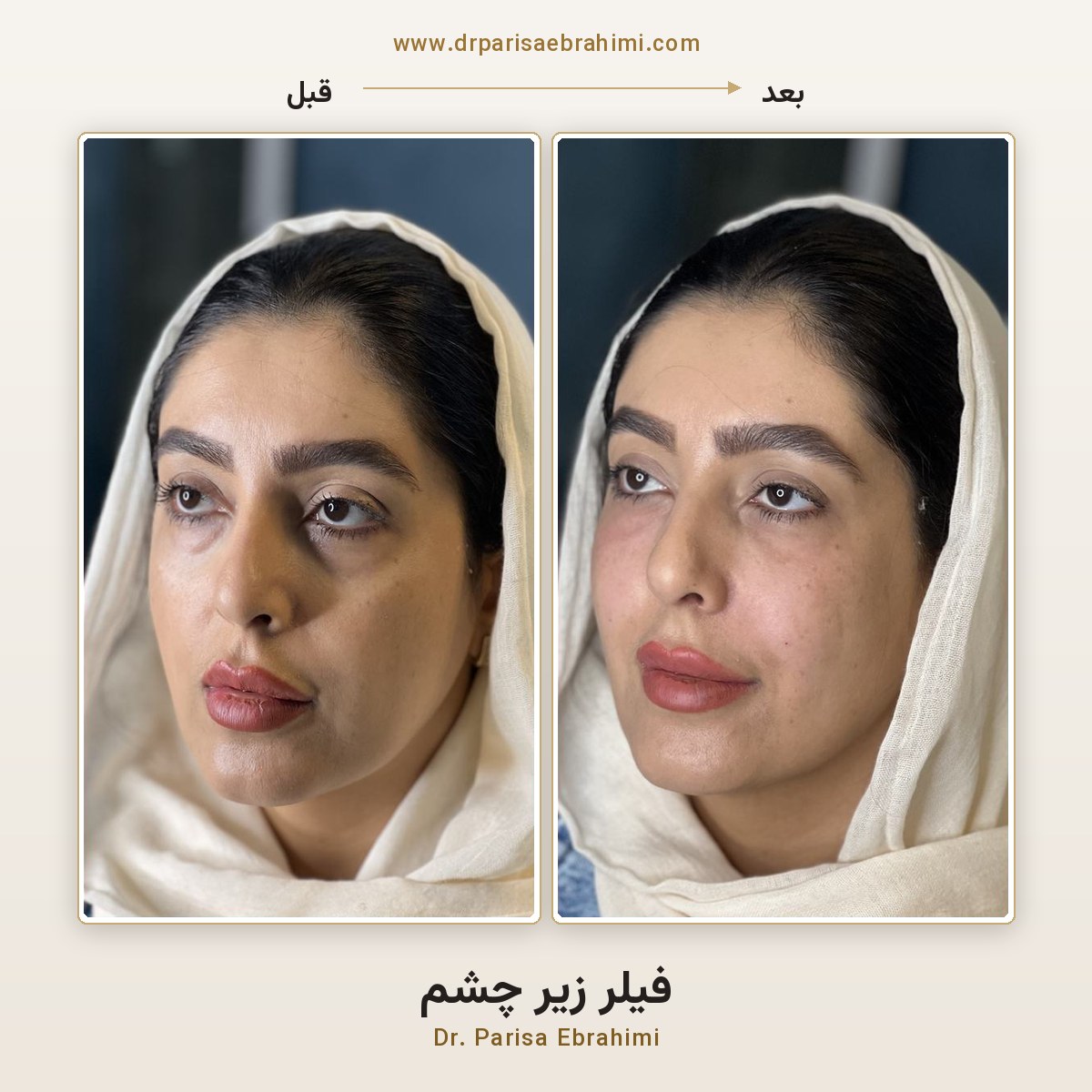 قبل و بعد تزریق فیلر زیر چشم در تهران — رفع گودی و سایه زیر چشم، دکتر پریسا ابراهیمی میرداماد