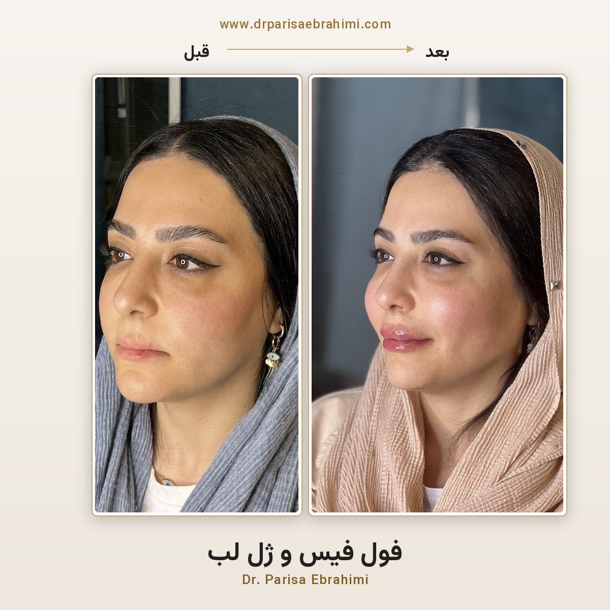 قبل و بعد تزریق فیلر فول فیس و ژل لب در تهران — جوانسازی کامل صورت، دکتر پریسا ابراهیمی میرداماد