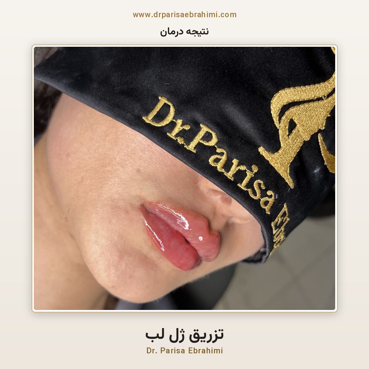 نتیجه تزریق ژل لب در تهران — نمای نزدیک فرم و حجم لب پس از درمان، دکتر پریسا ابراهیمی میرداماد