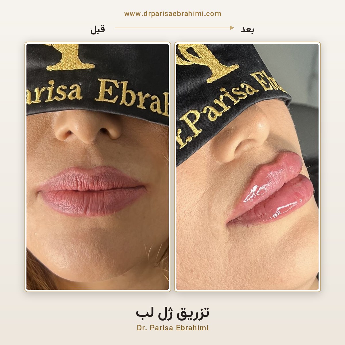 قبل و بعد تزریق ژل لب در تهران — حجمدهی و فرمدهی طبیعی لب، دکتر پریسا ابراهیمی میرداماد